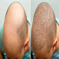 Hair Transplant in Chennai