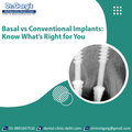 Basal vs Conventional Implants Know What is Right for You